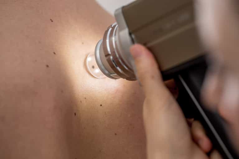 Mole mapping: A crucial tool for early detection and prevention of skin cancer Mole mapping: A crucial tool for early detection and prevention of skin cancer