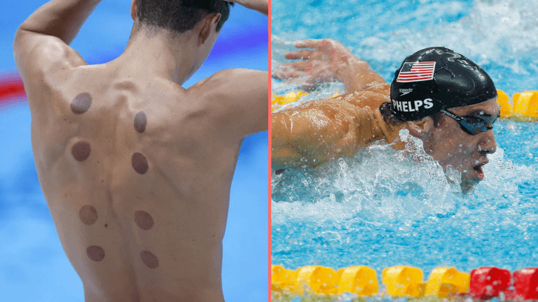 What are the dark circles on swimmers’ backs at Paris Olympics What are the dark circles on swimmers’ backs at Paris Olympics