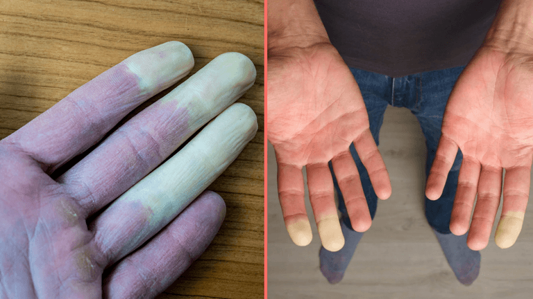 Millions of women suffer common disease where fingers turn white during winter months Millions of women suffer common disease where fingers turn white during winter months
