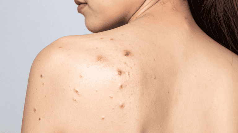 This is the perfect product to use if you suffer from stubborn body acne This is the perfect product to use if you suffer from stubborn body acne