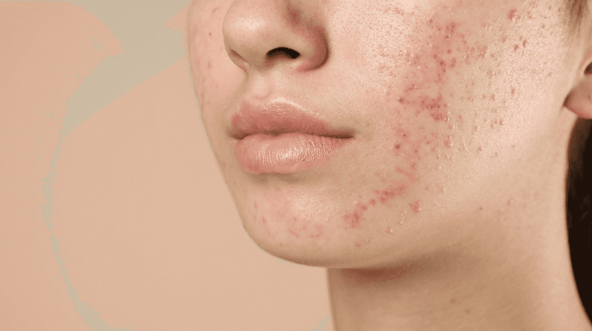 I’ve had acne for decades but this cleanser has finally helped clear my skin up I’ve had acne for decades but this cleanser has finally helped clear my skin up