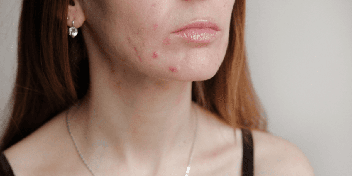 ‘This €26 acne serum worked wonders for my latest breakout’