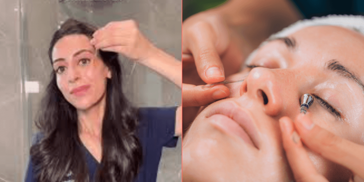 Dermatologist explains how to actually get rid of dark under eye circles