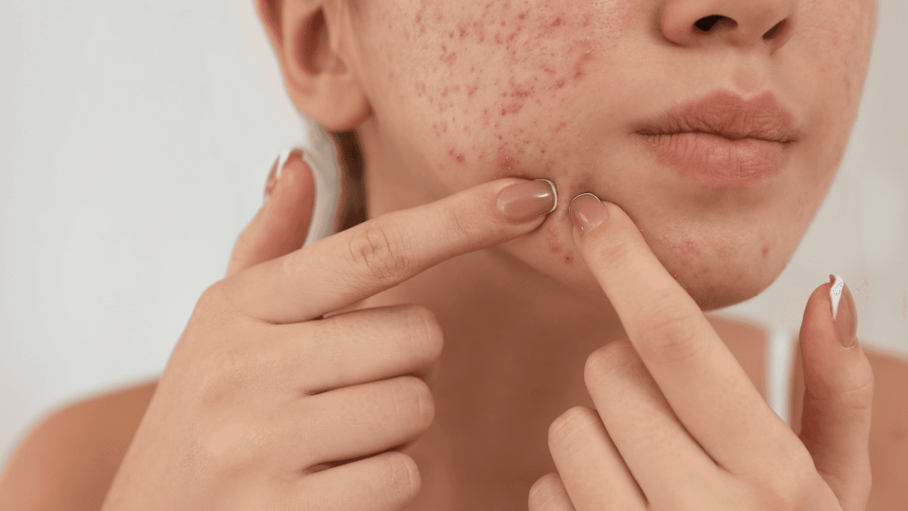 These €10 pimple patches supposedly get rid of your spots overnight