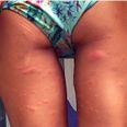 And We Thought She Had Class… Celebrity Shares Photo Of Her Mosquito-Bitten Backside