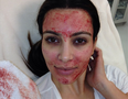 Bloody Hell… What Happened Kim Kardashian’s Face?