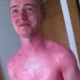 PICTURE: This Irish Guy Will Convince You To Wear Sunscreen