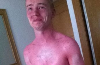 PICTURE: This Irish Guy Will Convince You To Wear Sunscreen