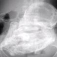 82-Year-Old Woman Carried Calcified Foetus For 40 Years