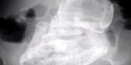82-Year-Old Woman Carried Calcified Foetus For 40 Years