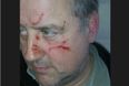 Fine Gael Councillor Allegedly Assaulted While Canvassing In Cork