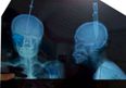 Close To The Bone! Woman Survives 11cm Knife Wedged In Her Skull