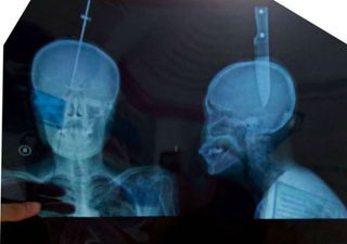 Close To The Bone! Woman Survives 11cm Knife Wedged In Her Skull