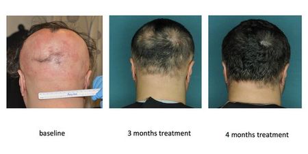 Alopecia Drug Restores Hair In Just Five Months