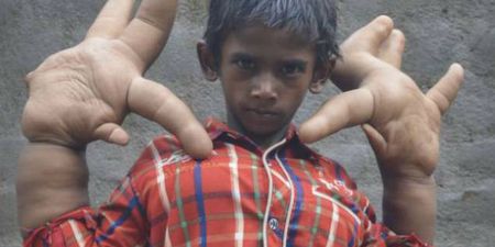 Boy Shunned From School After His Hands Grow Larger Than His Head