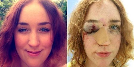 Woman Shares Selfie After Being Punched In The Face For “Telling Man To Stop Groping Her”