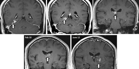 Doctors Discover Parasitic Tapeworm Living In Man’s Brain For Four Years