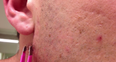 WATCH: Man Removes Possibly The Longest Ingrown Hair Ever Seen