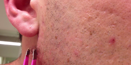 WATCH: Man Removes Possibly The Longest Ingrown Hair Ever Seen