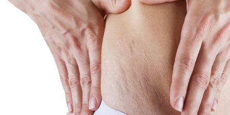 So This Is The Real Reason You Get Stretch Marks….
