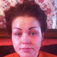 Woman Left With Four Eyebrows After Cosmetic Tattoo Went Wrong