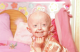 Progeria Campaigner Hayley Okines Dies Aged 17