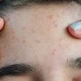 Research establishes a surprising fact for what causes acne
