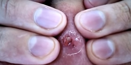 VIDEO: A 20-Year-Old Spot Being Popped is the Most Disgusting Thing You’ll Ever See
