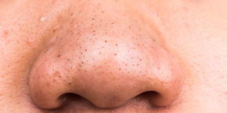 Plagued by Blackheads? This Might Be the Simplest Trick to Get Rid of Them