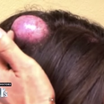 WATCH: Woman Gets Cyst The Size Of Egg Popped On Live TV