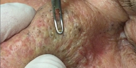 WATCH: The Disgusting Moment A Man Has Both His Pimples And Blackheads Popped At Once