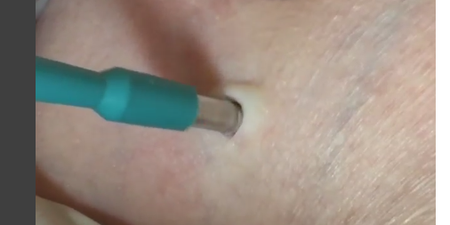 WATCH: You Won’t Believe What Was Pulled From The Cyst In This Woman’s Armpit…  