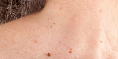 Here’s How You’re Developing Skin Tags (And How You Can Remove Them)