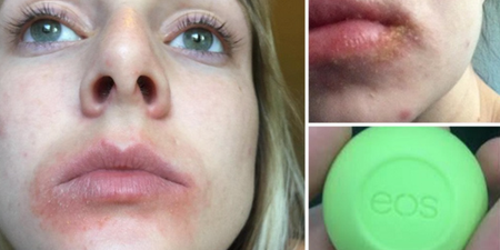 EOS is Reportedly Being Sued for Causing Severe Blisters