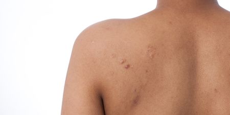 Doing this when washing your hair can cause bouts of back acne