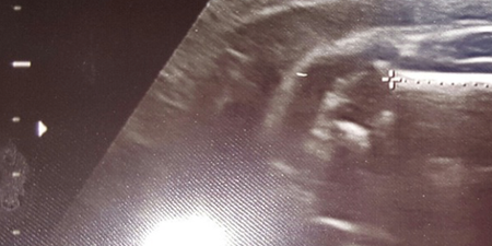 PIC: Expecting parents see shape of sports car on ultrasound scan