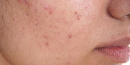 This everyday drink that we all rely on could be causing breakouts