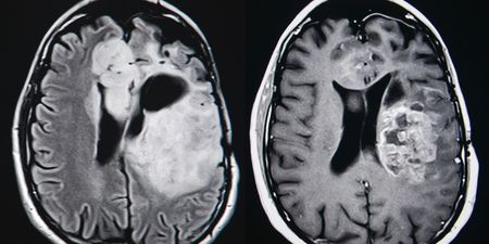 I have a tumour in my brain, and I’m happy about it