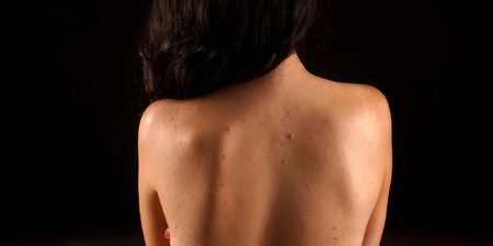 Ten things you need to know about psoriasis