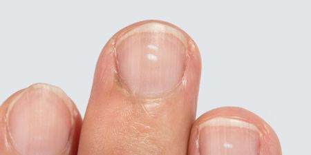 Here are the reasons why you may have white marks on your nails