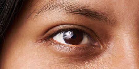 Dark circles around your eyes can indicate a common health complaint