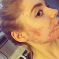 This woman cured her acute acne by making three lifestyle changes