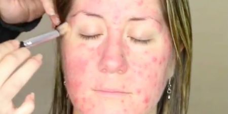 This incredible acne makeup tutorial is causing an awful lot of controversy