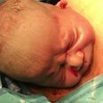 WATCH: Baby’s head ‘pops out’ of mum during ‘gentle C-section’