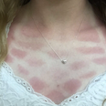 Terrible tan: 8 people who prove tan lines are the absolute worst
