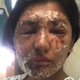 Acid attack survivor shares first incredible pictures of her recovery