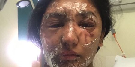 Acid attack survivor shares first incredible pictures of her recovery