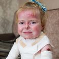5-year-old girl’s skin disease leaves her in full body bandages every day