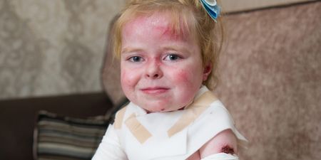 5-year-old girl’s skin disease leaves her in full body bandages every day