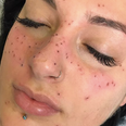 Tattooing freckles of your astrology sign is now a thing and we’re fairly confused